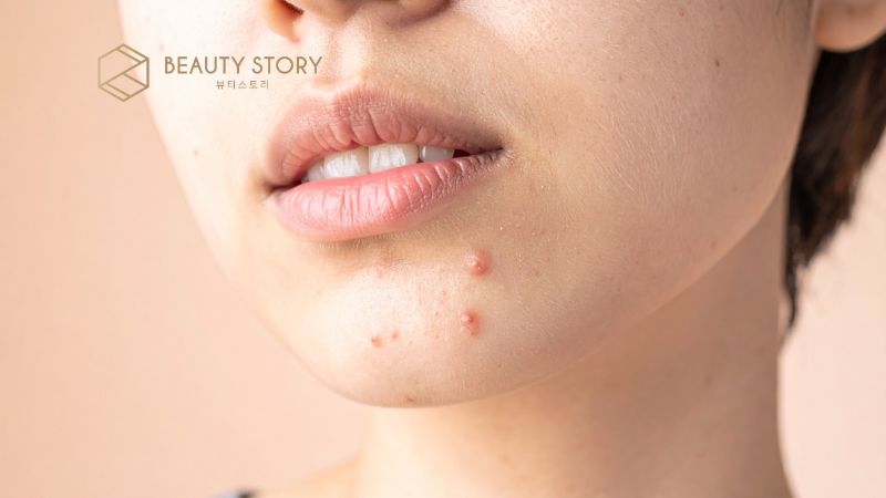 Dấu hiệu mụn sưng đỏ và quy trình chăm sóc da chuẩn y khoa